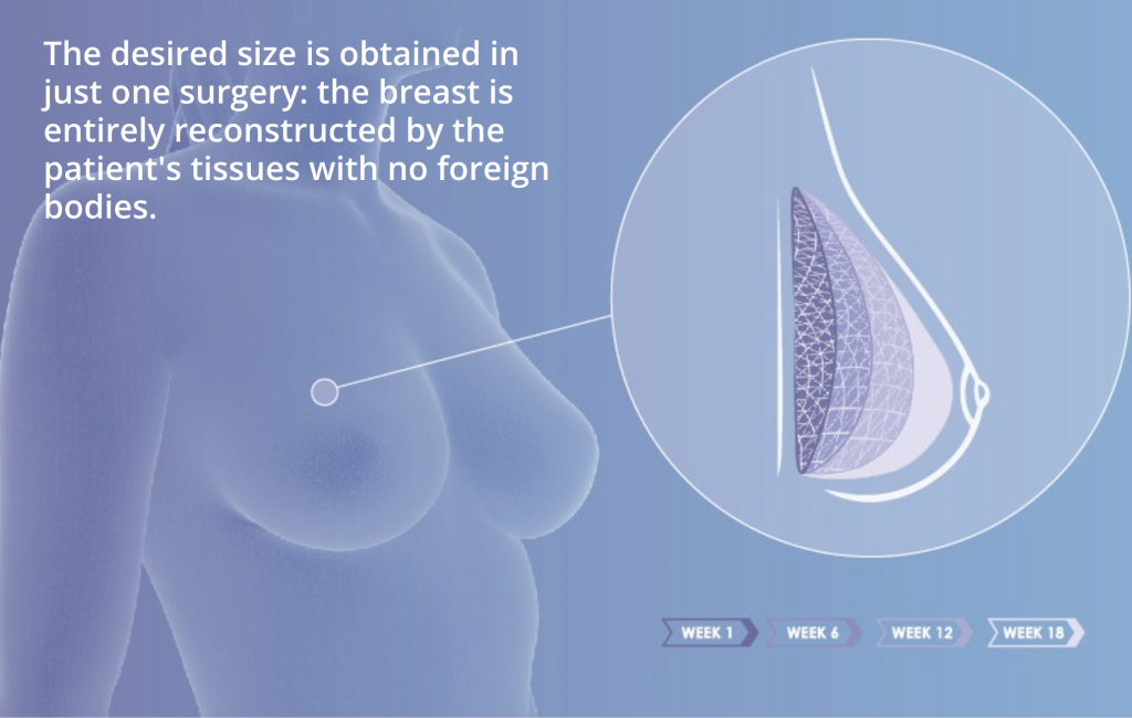 A diagram depicting the breast growth that can be achieved via Lattice Medical's implant. Image via Lattice Medical. 