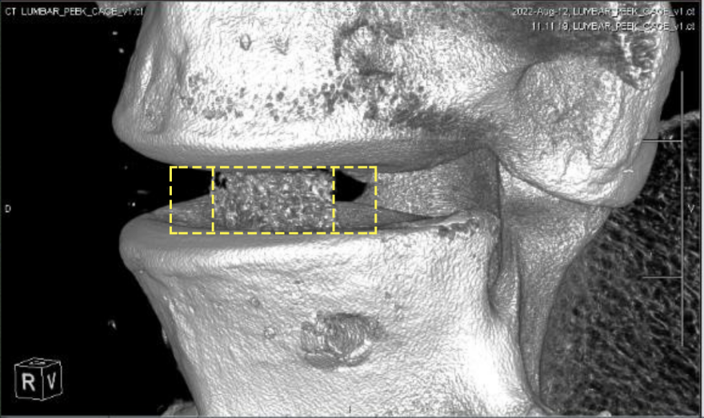 Image CT d'une cage vertébrale imprimée par Bond3D.  Image via Bond3D. 
