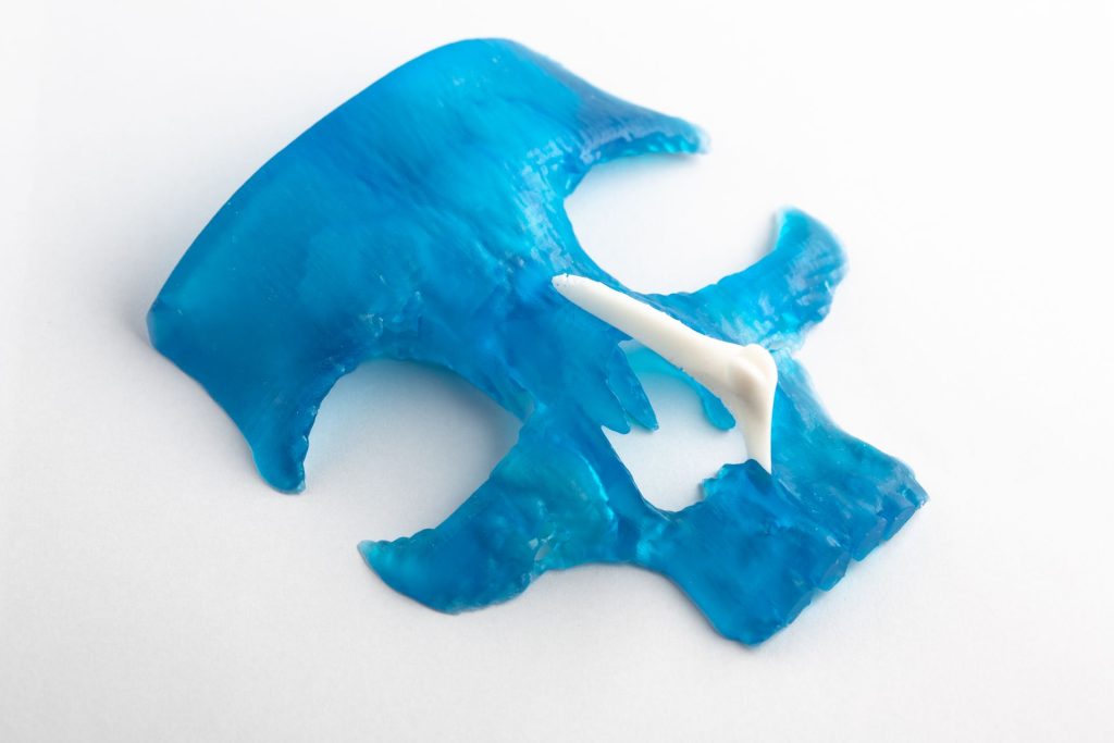 A CERHUM MyBone 3D printed facial bone graft. Image via CERHUM.