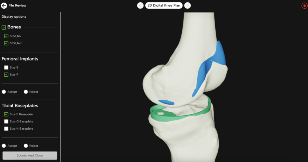 Planification numérique du genou 3D.  Image via les systèmes 3D.
