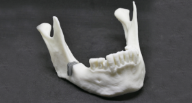 Mandibular model made of PLA with defect-fitting implant made of ZnMg, additively manufactured based on RWTH DAP’s newly developed design and alloy concept. Image via RWTH Aachen University.
