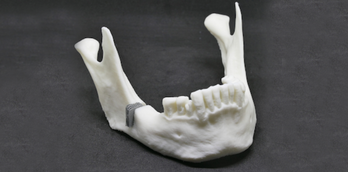 Mandibular model made of PLA with defect-fitting implant made of ZnMg, additively manufactured based on RWTH DAP’s newly developed design and alloy concept. Image via RWTH Aachen University.
