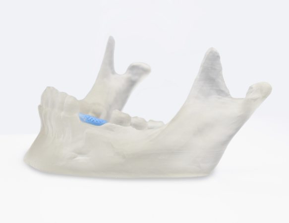A bioresorbable jawbone. Image via Lithoz.
