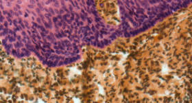 Light micrograph of a section through the surface of a tonsil showing the epithelium (pink) and underlying lymphoid tissue (brown). Image via Amgen.