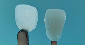 BMF develops ultra-thin veneers. Image via BMF.