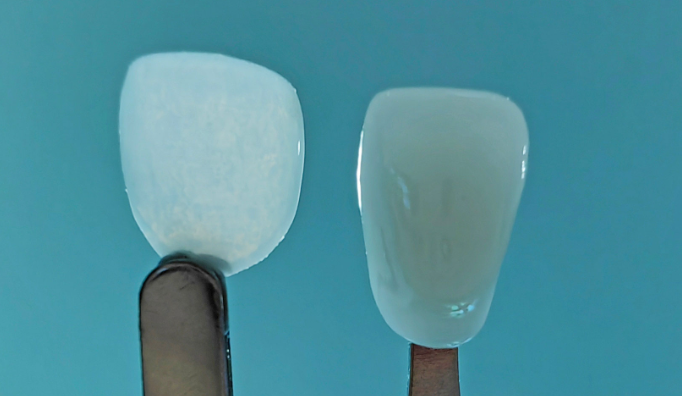 BMF launches the world’s thinnest cosmetic dental veneer giving a minimally invasive cure option