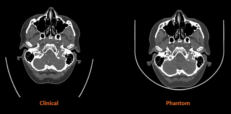 Comparison of Human CT Scan vs. CT Scan of Stratasys' 3D Printed Phantom. Photo via Stratasys.