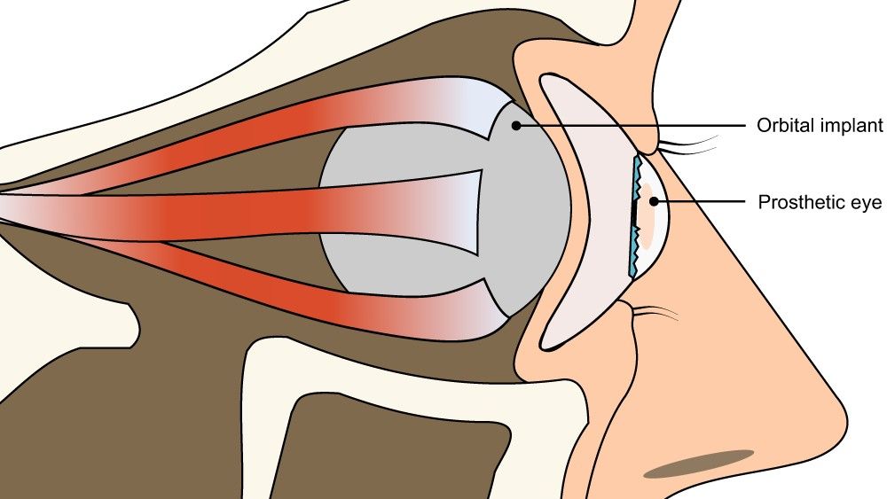 A prosthetic eye is usually placed between the eyelids and an "orbital implant" that sits in the eye socket. Image via Nature Communications.