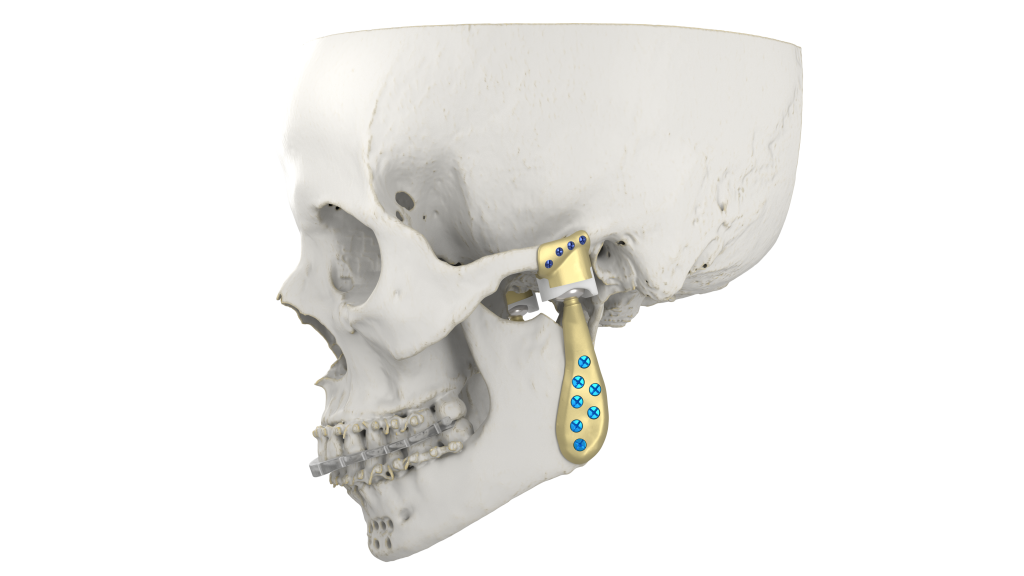 3D printed temporomandibular joint implant. Image via Materialise.