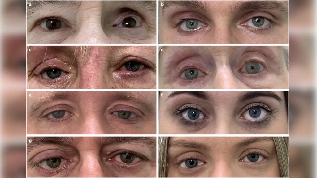 In the new study, 10 patients received 3D-printed prosthetic eyes, eight of whom are pictured above. Photos via Nature Communications