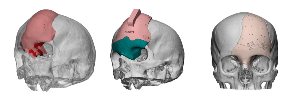 ArcomedLab's 3D printed cranial implants. Image via ArcomedLab.