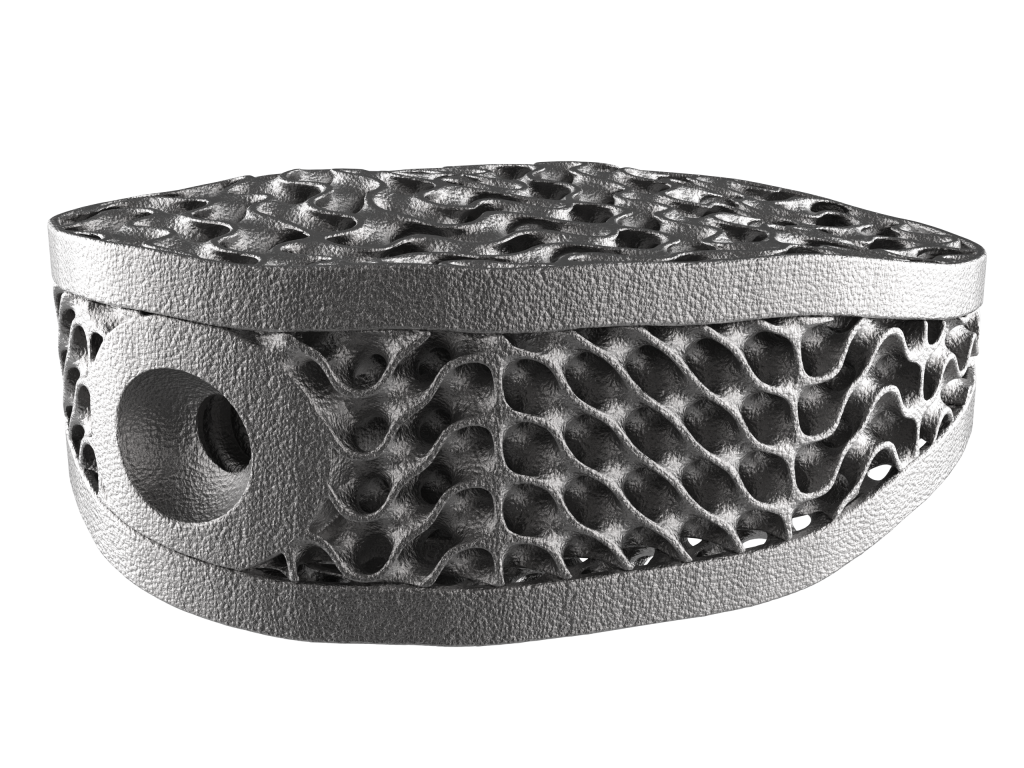 A 3D-printed spinal cage with lattice structures. Image via Oqton.