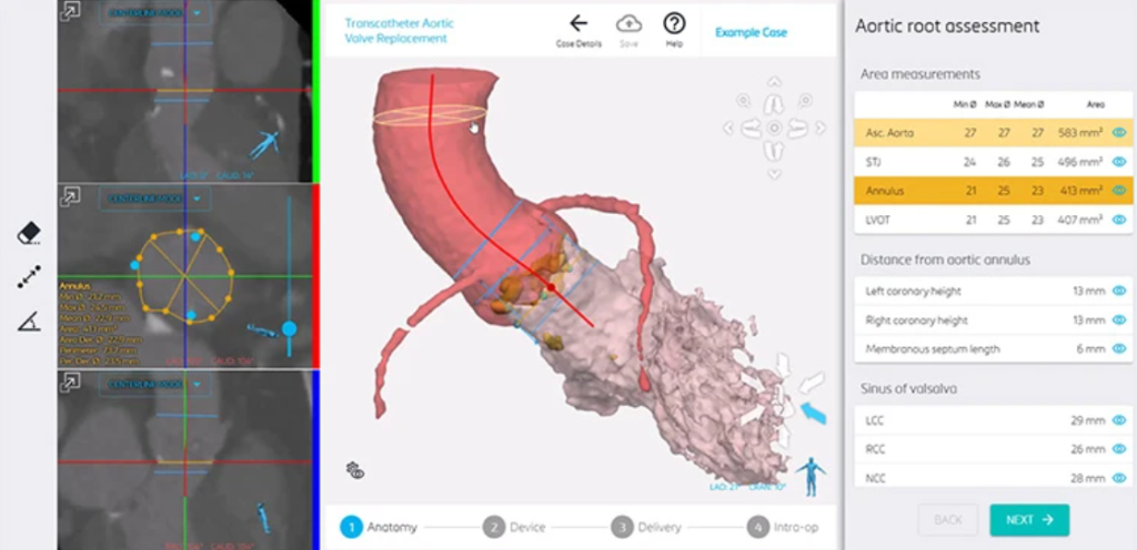 Anatomical overview for a TAVR procedure in Materialise Mimics Planner. Image via Materialise.