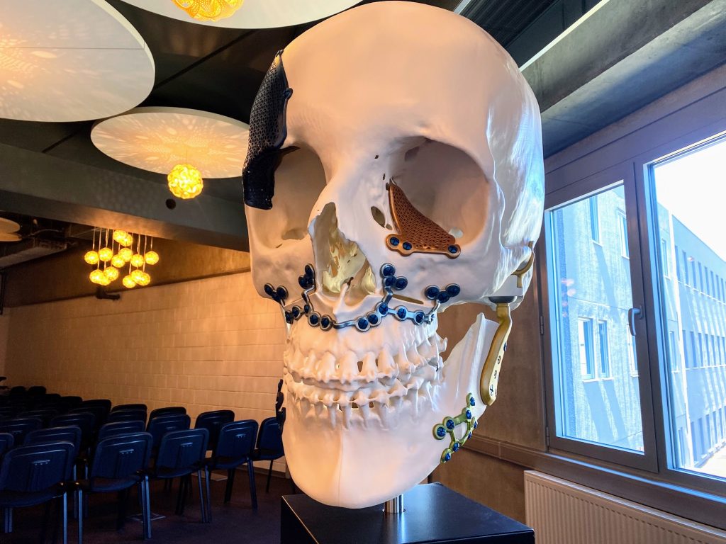 An example of cranio-maxillofacial implants 3D printed by Materialise. Photo by 3D Printing Industry