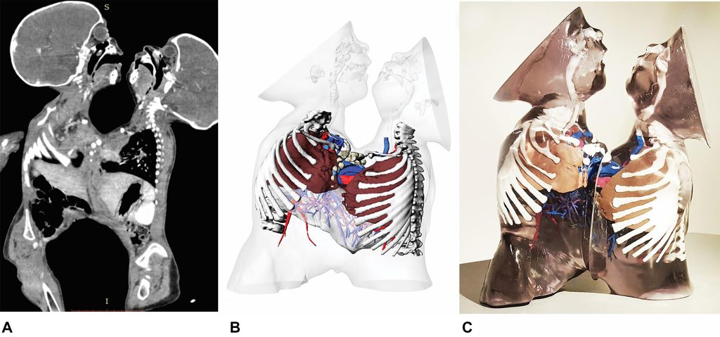 Dr. Davide Curione's workflow for creating 3D models of thoraco-omphalopagus twins. Image via Frontiers in Physiology