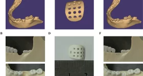 Customized mesh for alveolar bone defect repair. Image via Guangzhou Medical University.