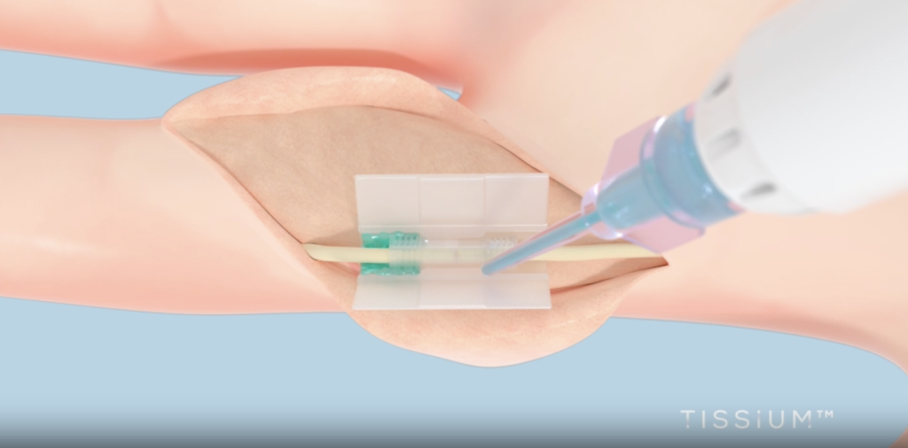 COAPTIUM CONNECT with TISSIUM Light. Image via TISSIUM.
