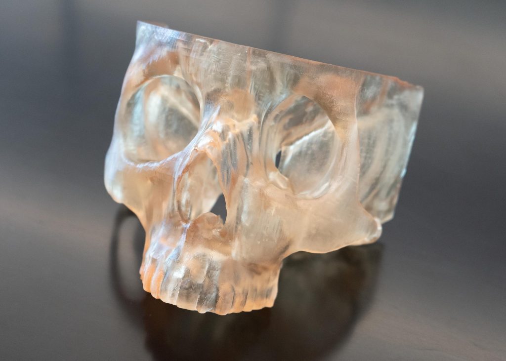 Wydrukowany w 3D model czaszki pacjenta, wyprodukowany w laboratorium M4. Zdjęcie za pośrednictwem OSUCC – Arthur G. James Cancer Hospital/Richard J. Solove Research Institute.