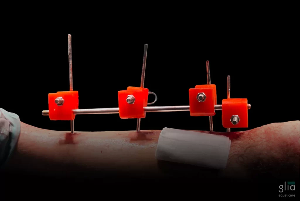 3D printed external fixator. Photo via Glia.