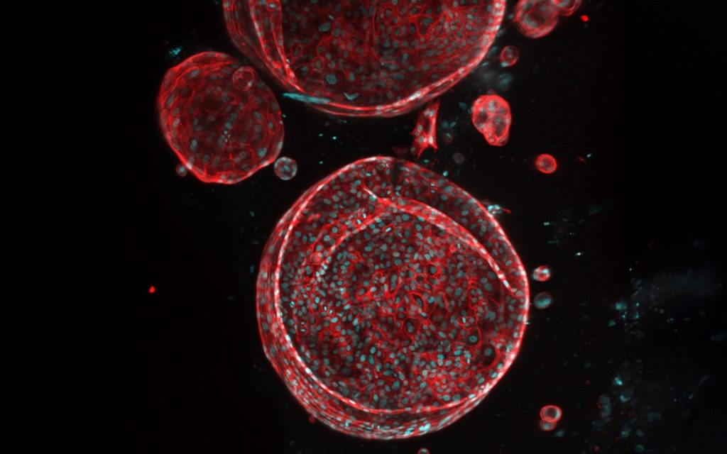 Patient biopsy-derived liver organoids can serve as building blocks for biofabrication of a personalized, patient-specific whole liver. This image shows liver organoids generated from a patient liver biopsy with alcoholic liver disease. CD44 is shown in red marking liver organoids, and cell nuclei are shown in blue. (Photo credit: Sunil Shrestha, Ph.D., postdoctoral fellow, Rizwan Lab / UTSW.)