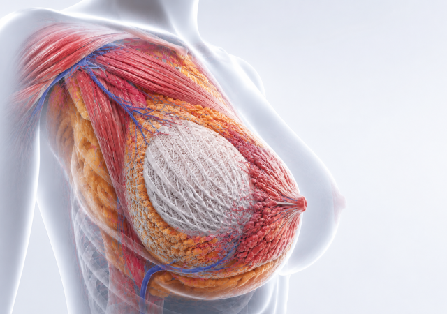 BellaSeno's polycaprolactone breast scaffold shown in situ. Image via BellaSeno.