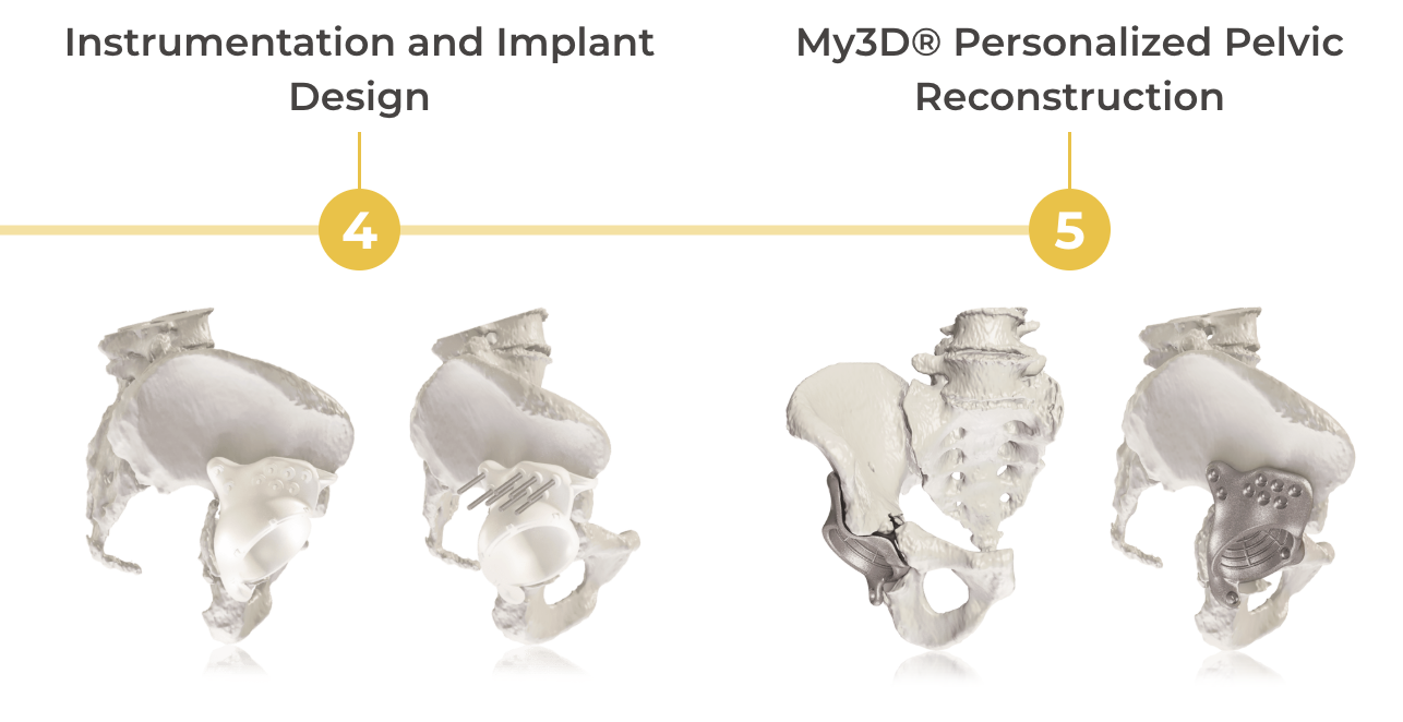 Onkos Surgical’s 3D printed My3D pelvic platform crosses 1,000 surgical cases