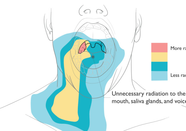 Stentra, an FDA-cleared Custom Mouthpiece for Head and Neck Cancer Radiation Therapy. Image via Kallisio.