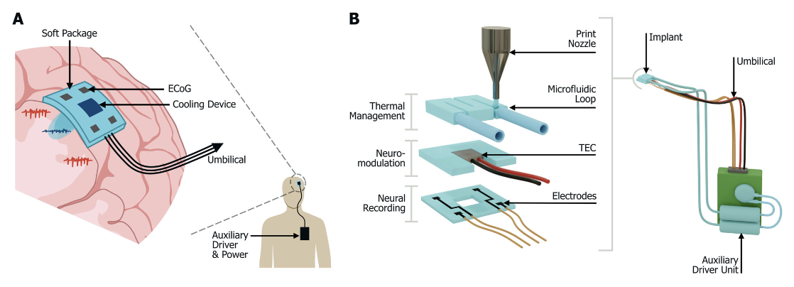 3D Printed Brain Cooling Implant Targets Drug-Resistant Epilepsy - 3D Printing Industry